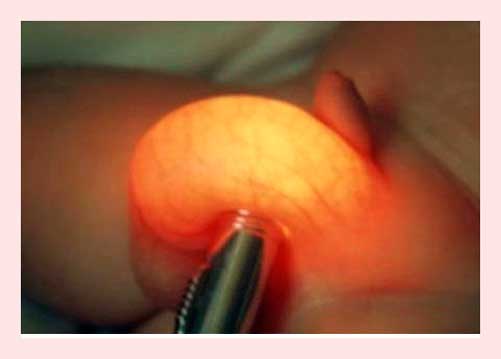 диафаноскопия яичка у ребенка