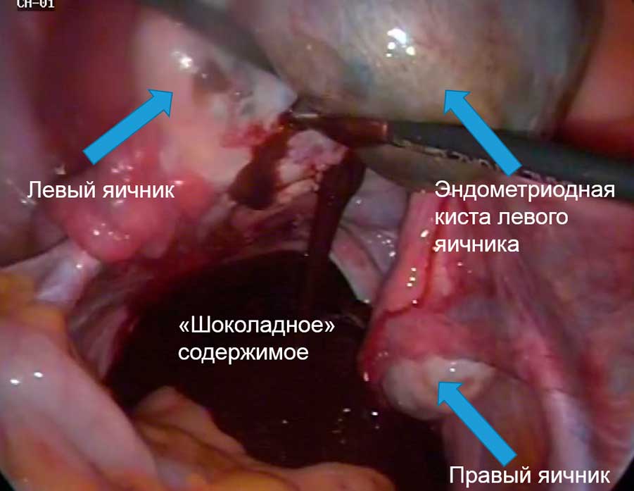 фото содержимого эндометриодной кисты левого яичника